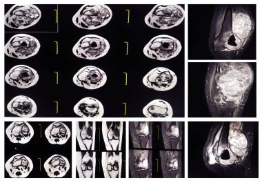 Koleksiyon MRI diz: distal lateral femoral metaphysis, iyi tanımlanmış bir kemik yıkım ile çoklu Kistik çevreleyen tümör, önceden varolan konumunu temsil eden.