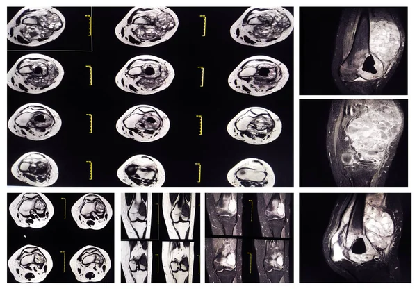 コレクション Mri 遠位外側大腿骨骨幹端に腫瘍 嚢胞性の複数の明確に定義された骨の破壊と周辺の既存の位置を表す — ストック写真