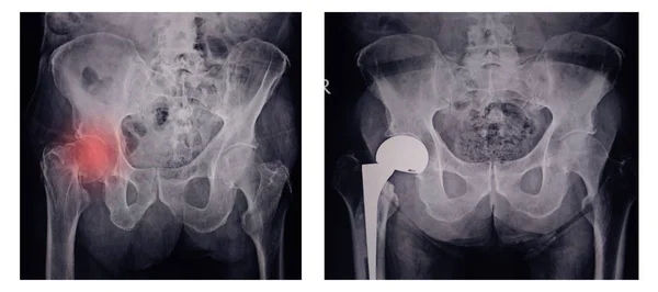 x--ray image of painful hip in woman present fracture right hip joint at red area mark with orthopedic hip joint replacement implant head and screws in human skeleton in blue gray tones.