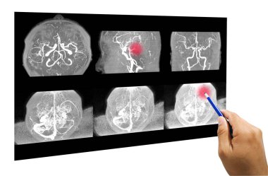 Beyin veya serebral arterin manyetik rezonans anjiyografisi