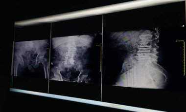 X-ray görüntü leğen kemiği ve kalça eklemi, dejeneratif L4-5 