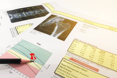 Kalça ve omurga mineral yoğunluğu (Bmd) Dexa densitometri kalçası 