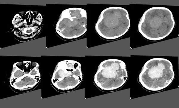 CT Scan Brain Axial scans with 5 mm slice thickness from OM-line