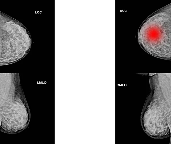 Both side collection of Mammogram radio imaging for breast cance — Stock Photo, Image