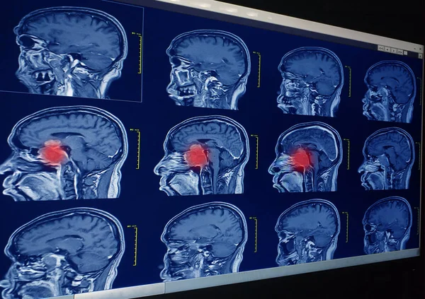 Ressonância magnética (RM) do cérebro , — Fotografia de Stock