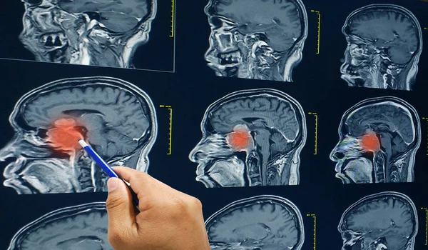 Ressonância magnética (RM) do cérebro, tumor cerebral , — Fotografia de Stock