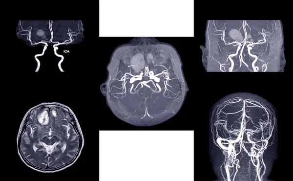 MRA Y MRV DEL CEREBRO :, — Foto de Stock