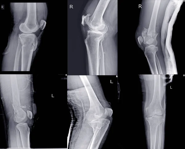 Złamanie zbioru rentgenowskiego stawu kolanowego różne widoki. — Zdjęcie stockowe