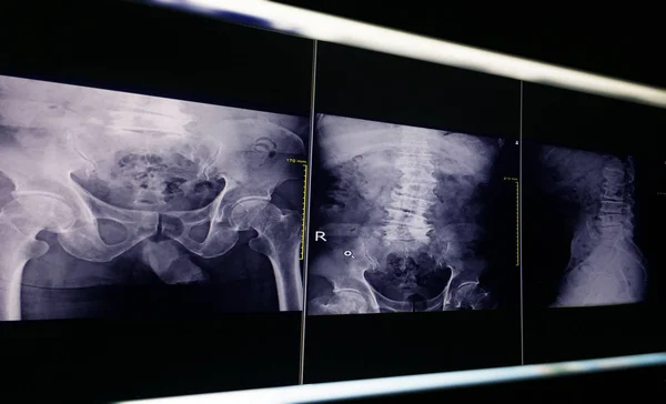 x-ray image pelvic bone and hip joint, degenerative change L4-5