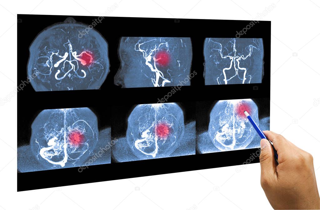 MRA brain or Magnetic resonance angiography of cerebral artery