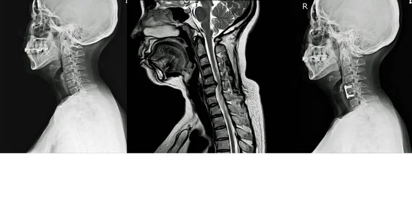 Рентген и МРТ шейного отдела позвоночника История боли в шее, излучают — стоковое фото