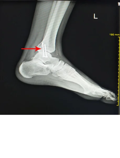 Rentgenowskie stopy po operacji naprawić śruby w kości piszczelowej środkowej. — Zdjęcie stockowe