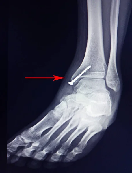Rentgenowskie stopy po operacji naprawić śruby w kości piszczelowej środkowej. — Zdjęcie stockowe