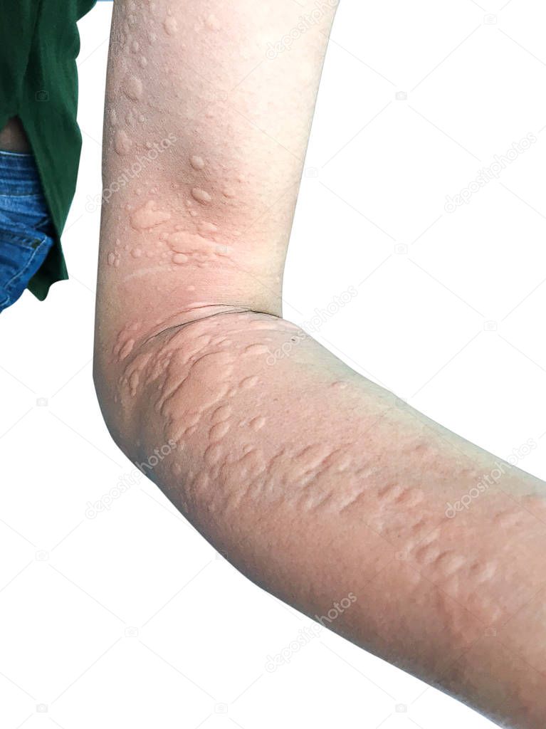 Allergic skin reaction on the female urticaria on the arm skin- 