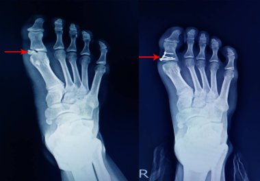 X-ray ayak kırığı proksimal phalang ve ameliyat mini plakayı düzeltir. 