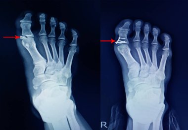 x-ray foot fracture proximal phalang and surgery fix mini plate  clipart