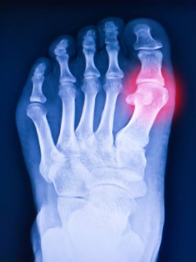 X-ray foot and arthritis at metatarsophalangeal joint (Big toe a clipart