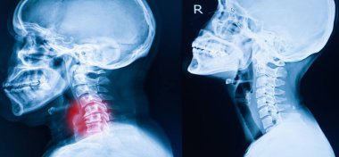 Servikal Omurga, boyun x-ray görüntü x-ray görüntüsü