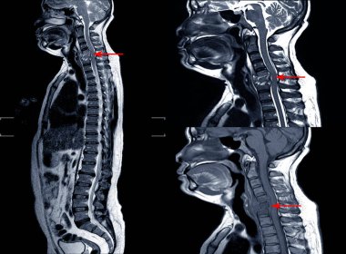 MRI Boyun röntgeni HNP veya TB omurgası olmadığını gösteriyor..