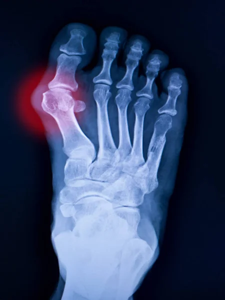 X-ray foot and arthritis at metatarsophalangeal joint (Big toe — Stock Photo, Image