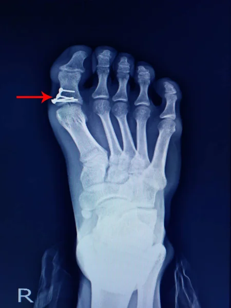 Рентгенівський перелом стопи проксимальний фаланг і хірургічне втручання фіксують міні-плиту — стокове фото