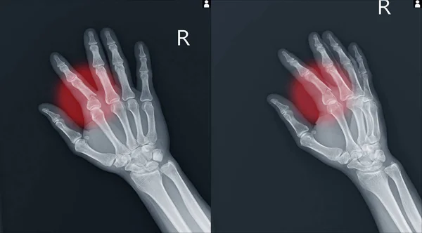Fractuur index proximale falanx.X-ray rechterhand (Ap, schuin) — Stockfoto