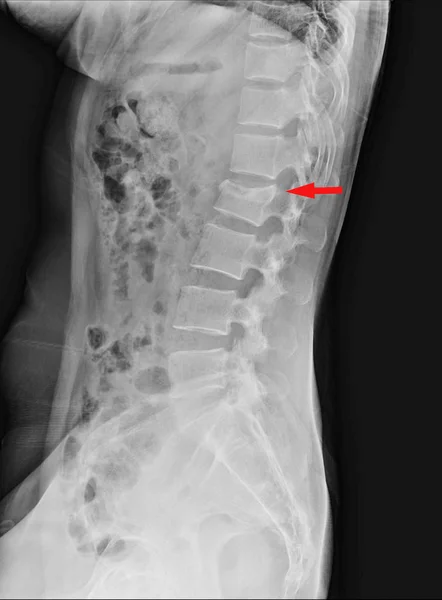 Lumbar spine compression fracture of L2.