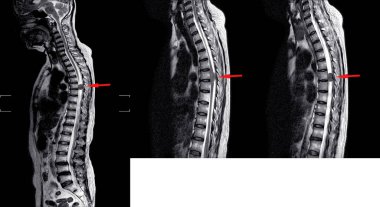 MRI omurgası.