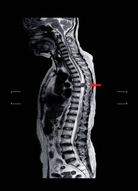 MRI omurgası.