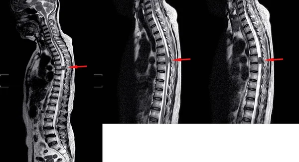 RM TL coluna vertebral — Fotografia de Stock