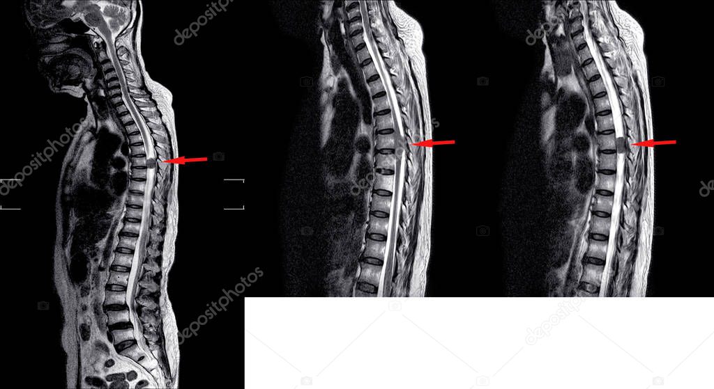 MRI TL spine �