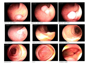 Tıbbi görüntü Gastrointestinal endoskopik inceleme, polip üst rektum bulma. ve Normal .