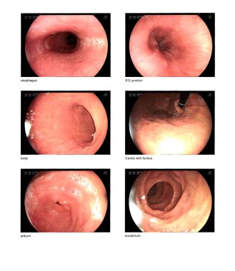 Tıbbi görüntü Gastrointestinal endoskopik inceleme görüntüsü. EGD (özofagoskopi) özofagus 'ta yapı bulma