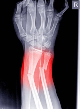 Bilek ekleminin sağ tarafındaki X-ray görüntüsü, renk işaretinde distal yarıçapı ve dirsek kemiğinde çatlaklar gösteriyor..