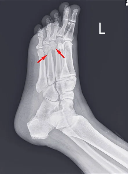 Kırmızı Noktasında Ayak Ayak Bileği Röntgeni Kırıkları Gösteriyor Metatarsal Kırıklar — Stok fotoğraf