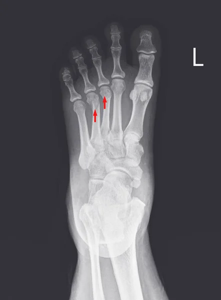 Kırmızı Noktasında Ayak Ayak Bileği Röntgeni Kırıkları Gösteriyor Metatarsal Kırıklar — Stok fotoğraf