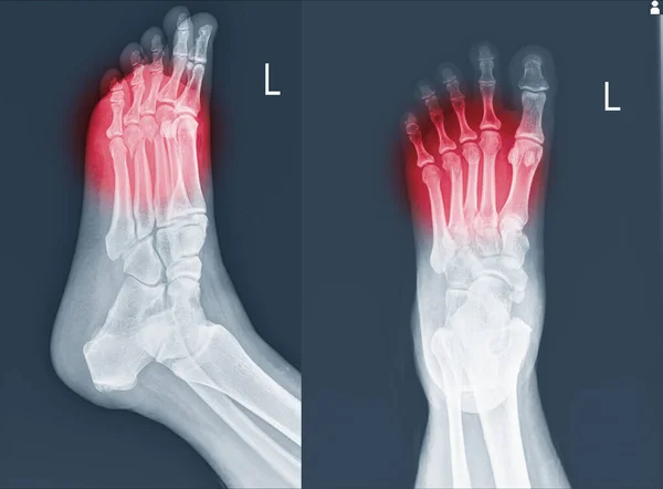 赤い点で転移性骨折を示すX線足と足首 ラット 転移性骨折は足の最も一般的な傷害の1つである — ストック写真