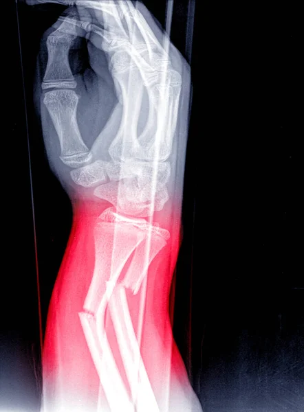 Ray Image Right Wrist Joint Shows Fracture Distal Radius Ulna — Stock Photo, Image