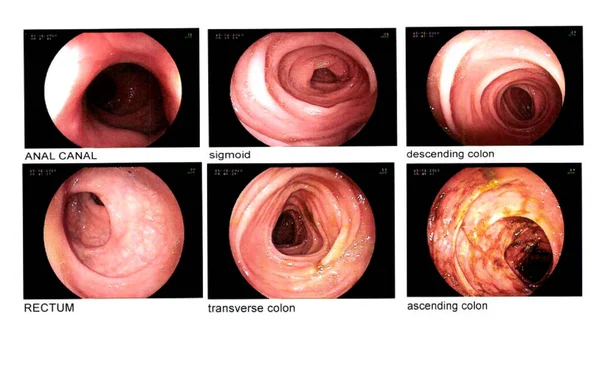 结肠镜图像 血管内 乙状结肠 下腔结肠 横结肠 结肠末梢结肠 — 图库照片