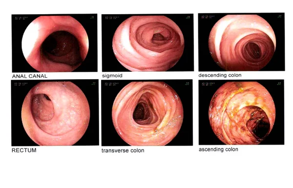 Kolonoskopi Görüntüsü Organlar Anal Kanal Sigmoid Inen Kolon Rektum Enine — Stok fotoğraf