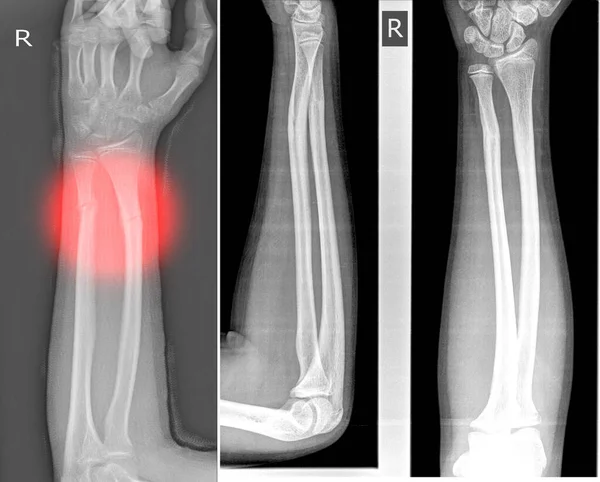 Röntgenkép Jobb Csuklóízület Mutatja Lépés Törés Disztális Orsó Singcsont — Stock Fotó