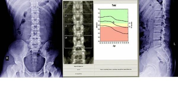 X光腰椎 骶骨脊柱和骨盆以及脊椎和骨密度测量脊柱的炎症 — 图库照片