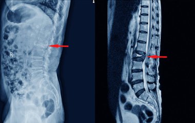 L1-2 omurga kırığının tıbbi röntgeni ve MR 'ı. L1-2 'den L5-S1 disklerine kadar lumbar spondiloz..