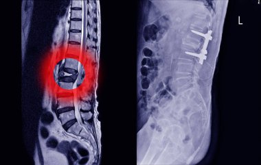 Kardiyolog doktor stetoskop tutuyor, göğüs röntgeni geçmişinde AICD kalp pili bulunan elektrokardiyogramı bulanıklaştırmış. Tıbbi konsept.