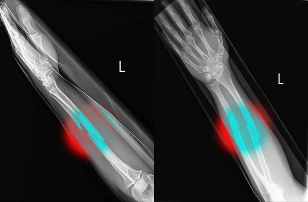 Kardiyolog Doktor Stetoskop Tutuyor Göğüs Röntgeni Geçmişinde Aicd Kalp Pili — Stok fotoğraf