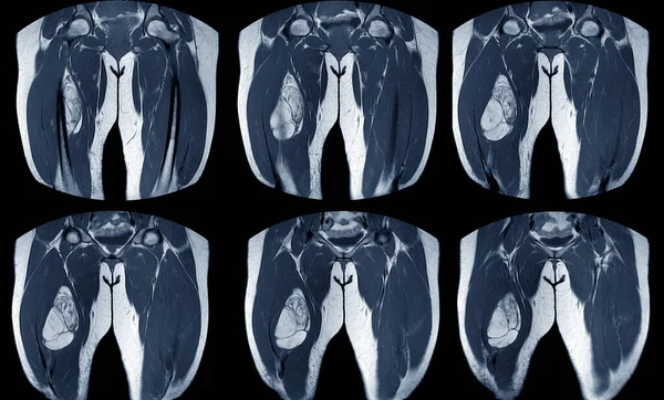 Ressonância Magnética Coxa Direita Achados Gordura Contendo Massa Vasto Intermedius — Fotografia de Stock