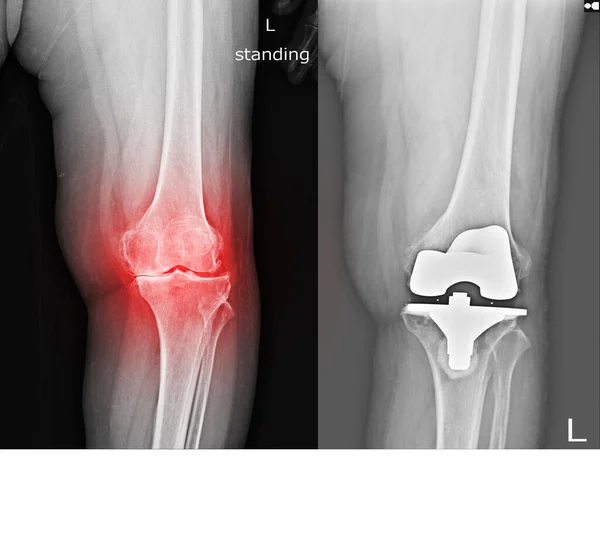 Radiografía Rodilla Izquierda Que Tiene Osteoartritis Regeneración Ósea Causando Dolor —  Fotos de Stock