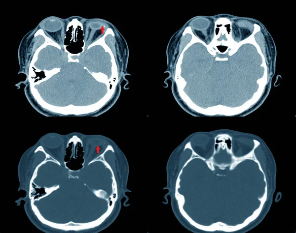 Scan Brain Orbit Case Accident Bottle Explodes Splashes Eyes Impression — Stock Photo, Image