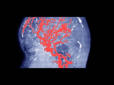 Beynin MRI ve MRA & MRV 'si. Sol tarafa 0.7 cm' lik orta çizgi kaymasıyla orta dereceli vasojenik ödem..