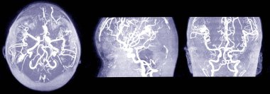 Beynin MRI ve MRA & MRV 'si. Sol tarafa 0.7 cm' lik orta çizgi kaymasıyla orta dereceli vasojenik ödem..